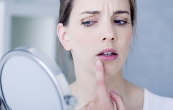 L'herpès labial : comprendre et traiter avec les produits pharmaceutiques